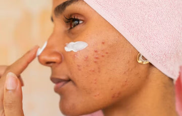 How to Get Clear Skin: A Simple Routine for Acne & Dark Spots
